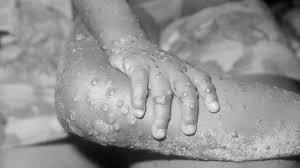 Kids below 5 years among new Mpox cases