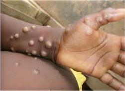 WHO: 14,700 confirmed mpox cases reported in Africa in 2024