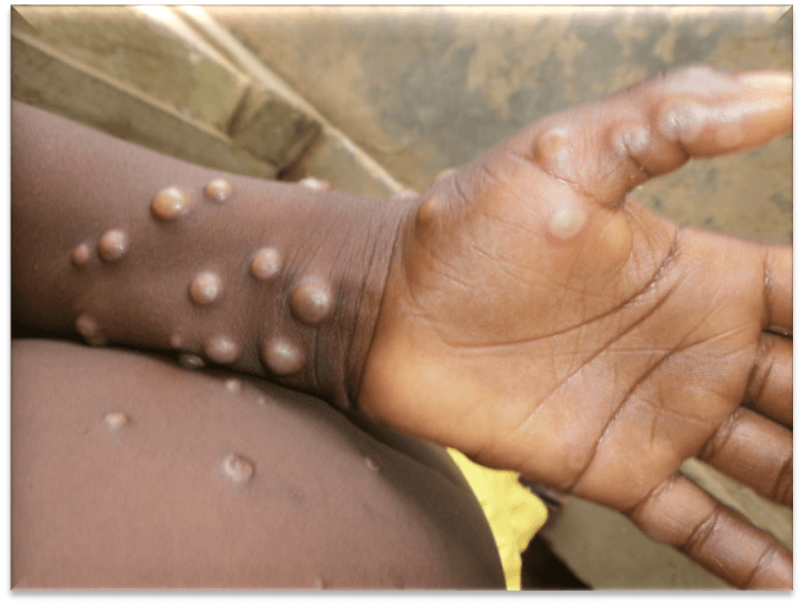 Why WHO has declined to lift Mpox emergency status