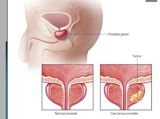 Prostate cancer battle: Barriers to men's health in Kenya