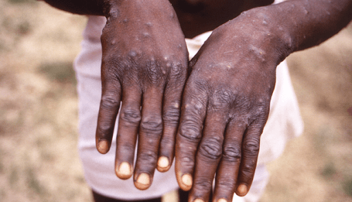 Mpox spread getting out of control, Africa CDC warns