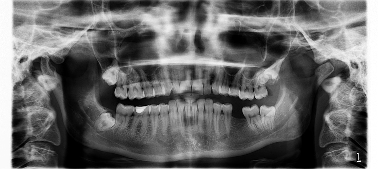 ART CHECK: Lesson from losing last molar tooth